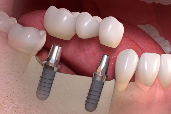 Visualisierung dreigliedrige Zahnkrone mit zwei Implantatposten im Unterkiefer