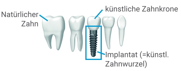 Zahnimplantat Wie der eigene Zahn AllDent